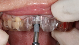 Guided Placement of Implant